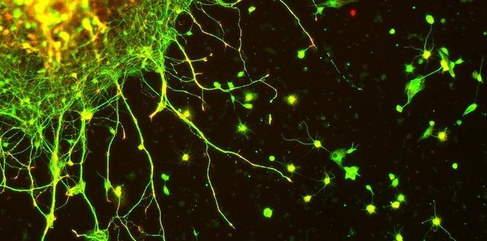 Common links between neurodegenerative diseases identified